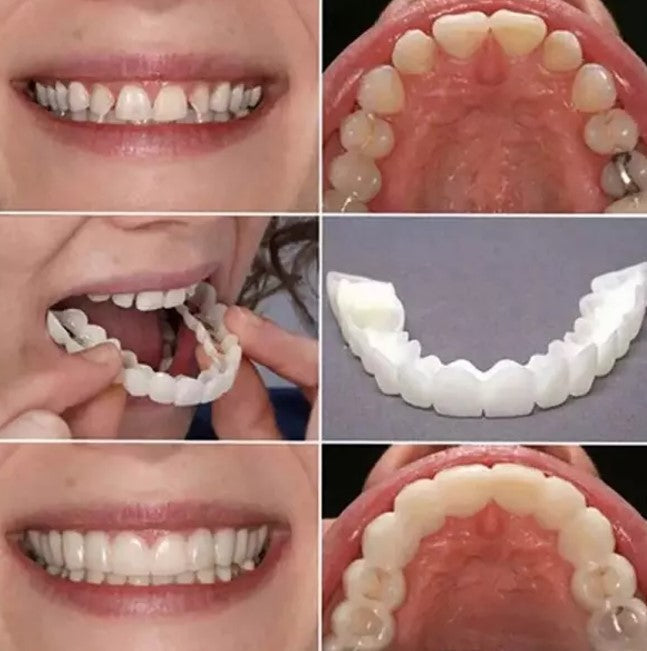 Carillas Dentales Cosmética Snapon Smile