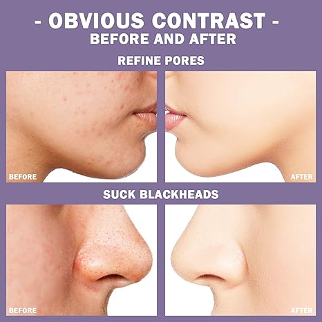 Roller Face Mascarilla Puntos Negros